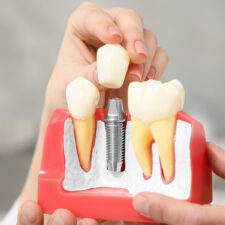 How to Maintain Proper Oral Care With Dental Implants