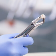 How Should You Deal With Severe Pain After Tooth Extraction?